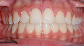 Orthodontic treatment after