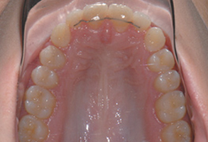 Orthodontic treatment after